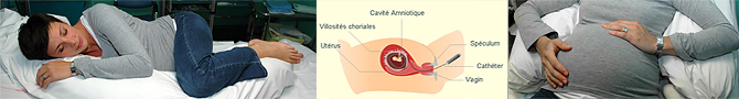 Biopsie de Trophoblaste