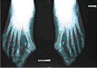 Diapo Métatarsalgies et griffes d’orteils 2