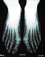 Diapo Métatarsalgies et griffes d’orteils 4