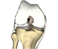 Schéma de la chirurgie du genou