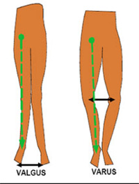 Schéma de la chirurgie du genou