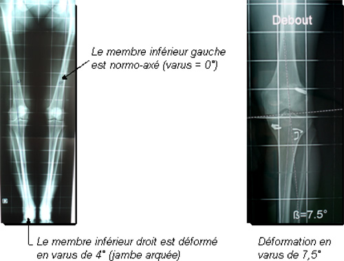 Schéma de la chirurgie du genou