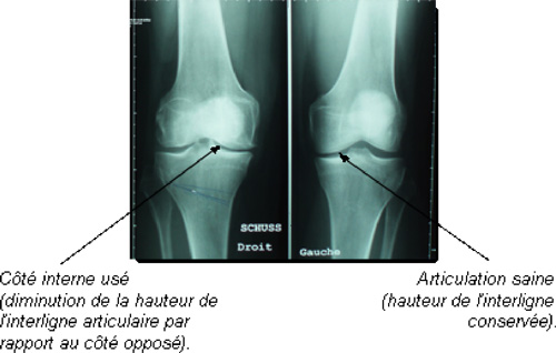 Schéma de la chirurgie du genou
