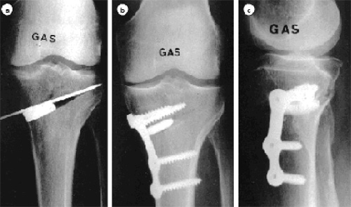 Schéma de la chirurgie du genou