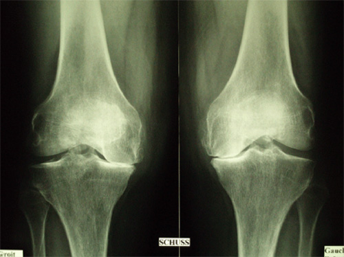 Schéma de la chirurgie du genou