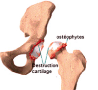 schéma de chirurgie de la hanche