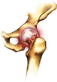 schéma de chirurgie de la hanche