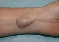 Photo d'une excroissance de la main