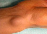 Photo d'une excroissance de la main