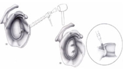 Schema chirurgie de la main