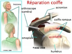 Schema chirurgie de la main