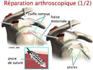 Schema chirurgie de la main