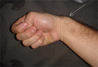 Schema chirurgie de la main