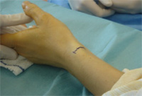 Schema chirurgie de la main