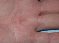 Pathologie de la main