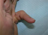 Photographie d'une pathologie de la main