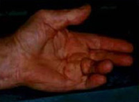 Photographie d'une pathologie de la main