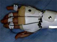 Photographie d'une pathologie de la main