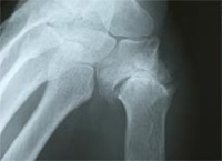 Radio chirurgie de la main