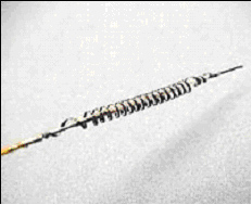 Photo de la figure 1 (Implant du procédé Essure) - Dr Bader 27-8-2009
