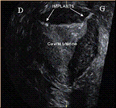 Photo de la figure 3 (Echographie 3D du procédé Essure) - Dr Bader 27-8-2009