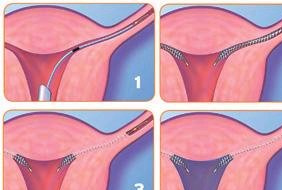 Photo de la figure 2 du procédé Éssure - Dr Bader 27-8-2009