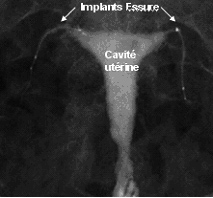 Photo de la figure 4 (Hystérosalpingographie du procédé Essure) - Dr Bader 27-8-2009