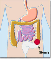 Photo d'une Stomie digestive